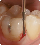 歯周病検査の様子